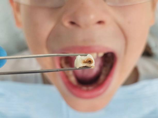 Best Broken Tooth Emergency  in Grafton, OH